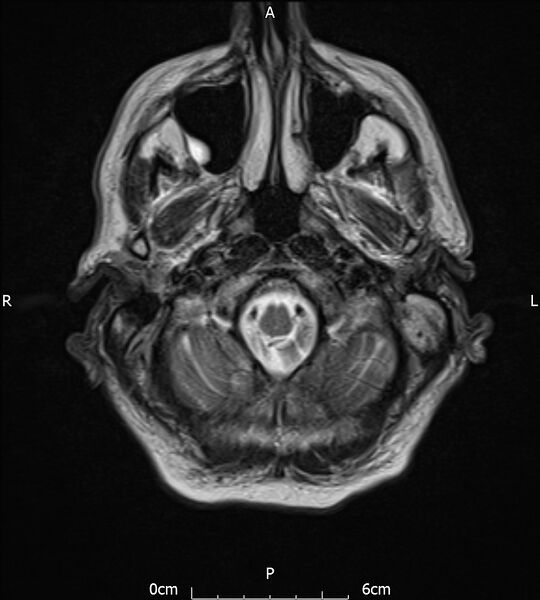 File:Cerebral amyloid angiopathy related inflammation (Radiopaedia 72772-83415 Axial T2 3).jpg