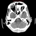 Cerebral and orbital tuberculomas (Radiopaedia 13308-13310 B 8).jpg