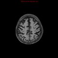 Cerebral and orbital tuberculomas (Radiopaedia 13308-13311 Axial T1 17).jpg