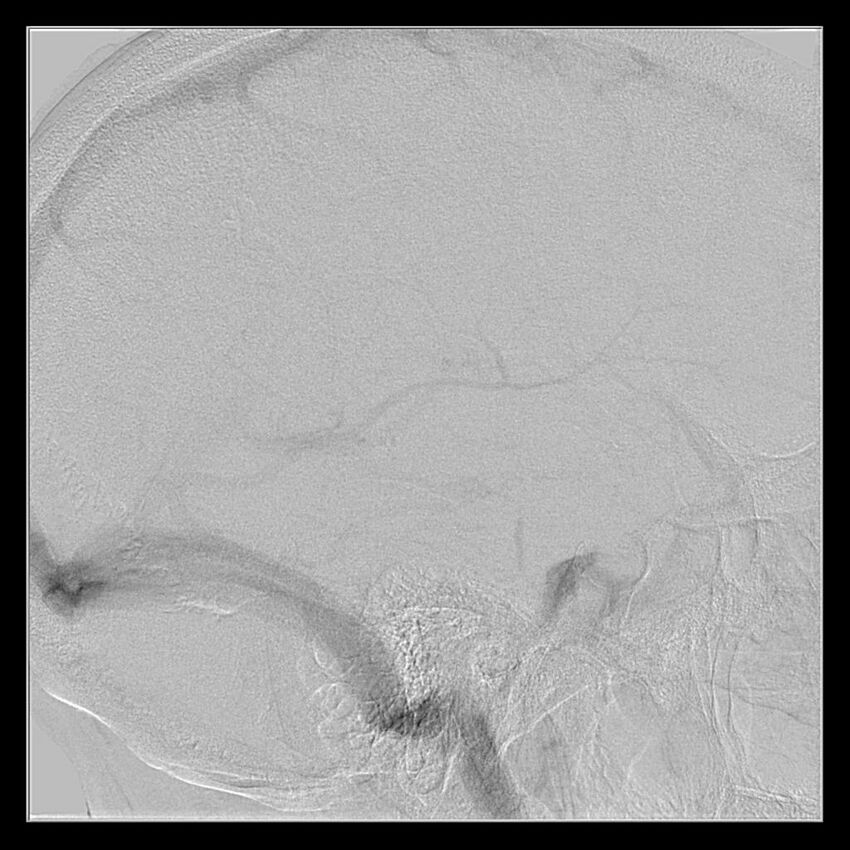 Cerebral aneurysm with rupture (Radiopaedia 29933-30458 LT CCA IC 50).jpg