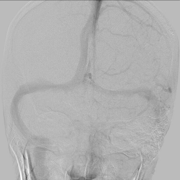 File:Cerebral aneurysm with rupture (Radiopaedia 29933-30458 LT ICA IC 24).jpg