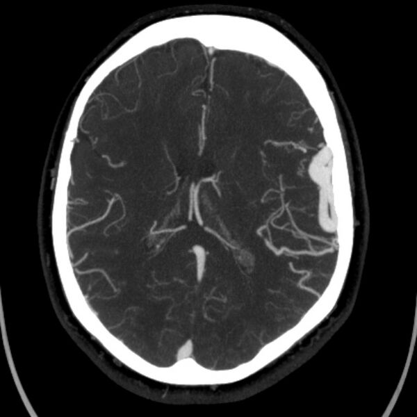 File:Cerebral arteriovenous malformation (Radiopaedia 43729-47189 B 29).jpg