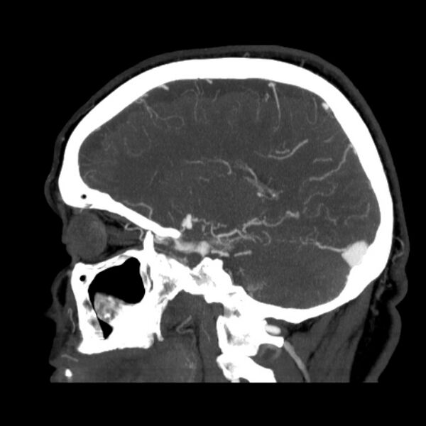 File:Cerebral arteriovenous malformation (Radiopaedia 43729-47189 D 18).jpg