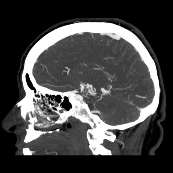 File:Cerebral arteriovenous malformation (Radiopaedia 43729-47189 D 29).jpg