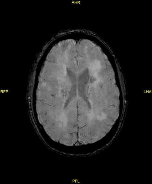 File:Cerebral autosomal dominant arteriopathy with subcortical infarcts and leukoencephalopathy (CADASIL) (Radiopaedia 86108-102054 Axial SWI 68).jpg
