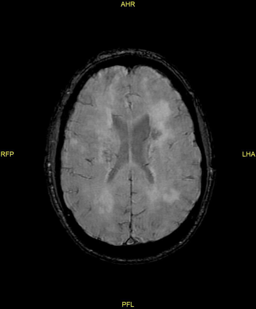 Cerebral autosomal dominant arteriopathy with subcortical infarcts and leukoencephalopathy (CADASIL) (Radiopaedia 86108-102054 Axial SWI 68).jpg