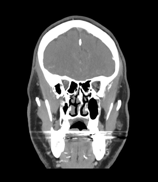 File:Cerebral dural venous sinus thrombosis (Radiopaedia 86514-102576 B 13).jpg