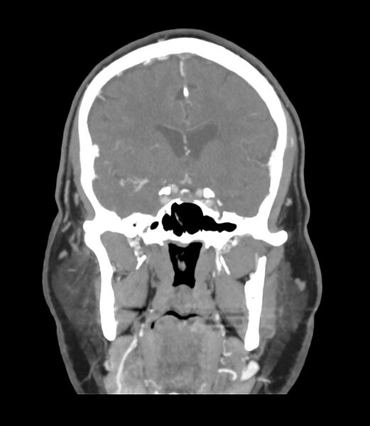 File:Cerebral dural venous sinus thrombosis (Radiopaedia 86514-102576 B 24).jpg