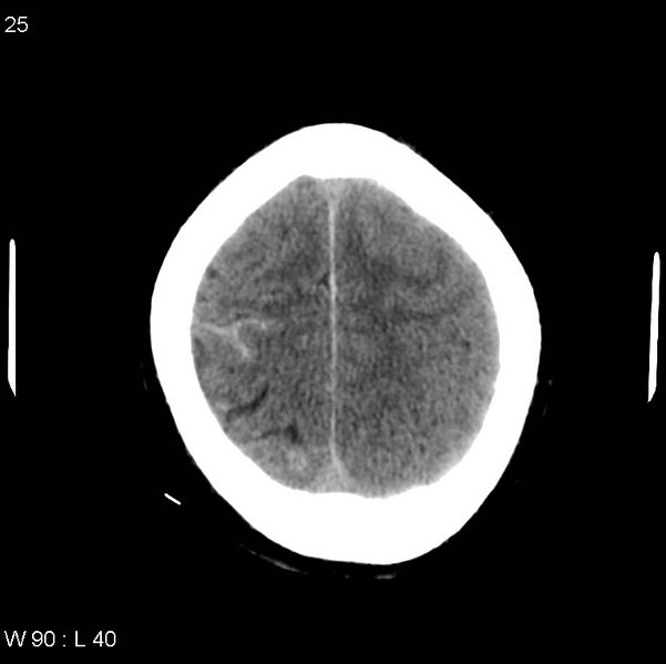File:Cerebral hemorrhagic contusion with subdural and subarachnoid hemorrhage (Radiopaedia 10680-19197 Axial non-contrast 21).jpg