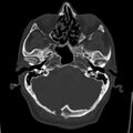 Cerebral hemorrhagic contusions (Radiopaedia 23145-23188 Axial bone window 11).jpg