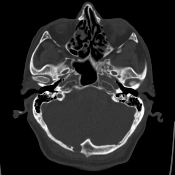 File:Cerebral hemorrhagic contusions (Radiopaedia 23145-23188 Axial bone window 11).jpg