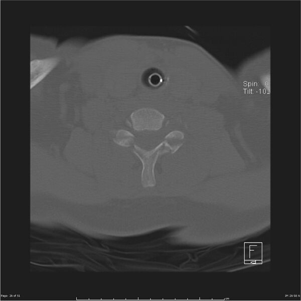 File:Cerebral hemorrhagic contusions and cervical spine fractures (Radiopaedia 32865-33841 C 26).jpg