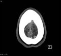 Cerebral vein thrombosis (Radiopaedia 4408-6629 Axial Venous phase 1).jpg