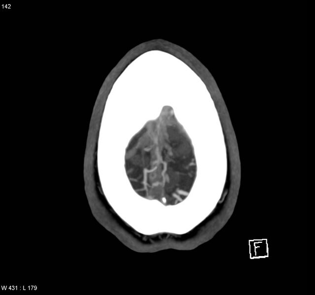 File:Cerebral vein thrombosis (Radiopaedia 4408-6629 Axial Venous phase 1).jpg