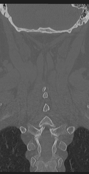 File:Cervical canal stenosis due to ossification of the posterior longitudinal ligament (Radiopaedia 47260-51823 Coronal bone window 49).png
