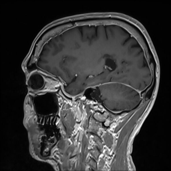 File:Cervical dural CSF leak on MRI and CT treated by blood patch (Radiopaedia 49748-54995 G 79).jpg