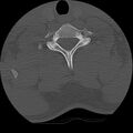 Cervical flexion teardrop fracture with cord hemorrhage (Radiopaedia 32497-33454 Axial bone window 67).jpg