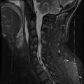 Cervical flexion teardrop fracture with cord hemorrhage (Radiopaedia 32497-33455 Sagittal STIR 12).jpg