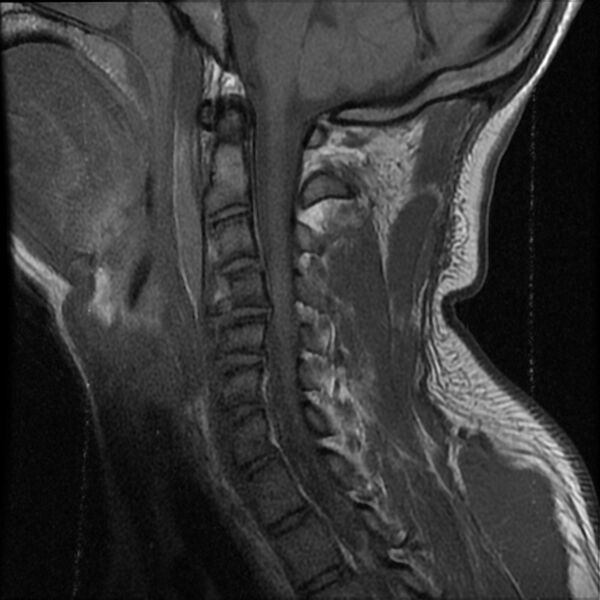 File:Cervical flexion teardrop fracture with cord hemorrhage (Radiopaedia 32497-33455 Sagittal T1 11).jpg