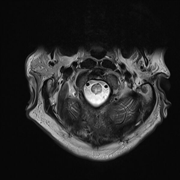 File:Cervical tumor-like myelopathy due to Type V dAVF (Radiopaedia 82461-96604 Axial T2 3).jpg