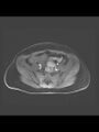 Cesarean section scar endometrioma (Radiopaedia 56569-63297 Axial T1 C+ fat sat 35).jpg