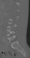 Chance fracture (Radiopaedia 40360-42912 Sagittal bone window 35).png