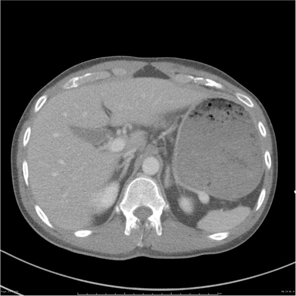 File:Chest and abdomen multi-trauma (Radiopaedia 26294-26426 A 23).jpg
