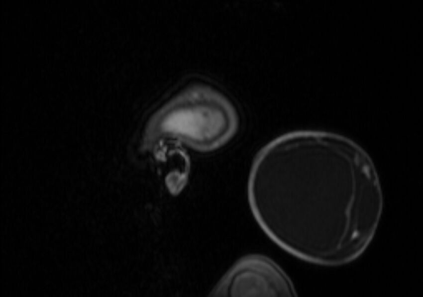 Chiari III malformation with occipital encephalocele (Radiopaedia 79446-92559 Sagittal T1 C+ mpr 11).jpg