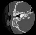 Cholesteatoma (Radiopaedia 20296-20217 bone window 22).jpg