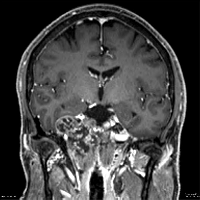 Chondrosarcoma of skull base- grade II (Radiopaedia 40948-43654 Coronal T1 C+ 12).jpg