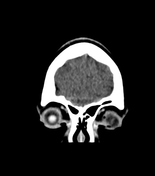 File:Choroid plexus carcinoma (Radiopaedia 91013-108552 Coronal non-contrast 9).jpg