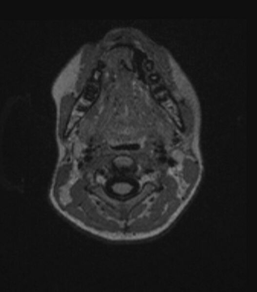 File:Choroid plexus carcinoma (Radiopaedia 91013-108553 Axial FLAIR C+ 34).jpg