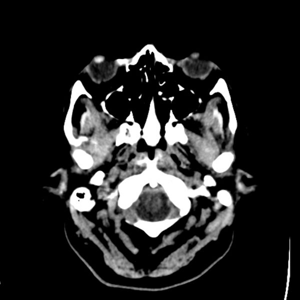 File:Chronic bilateral occipital lobe infarcts (Radiopaedia 31276-31996 Axial non-contrast 3).jpg