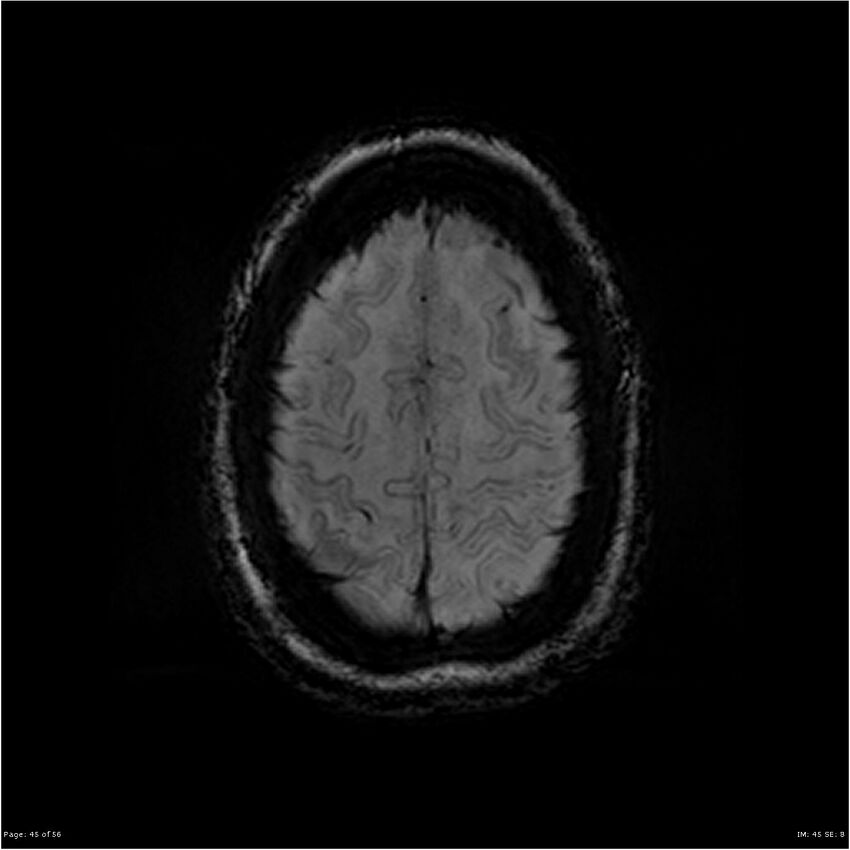 Chronic hypertensive encephalopathy (Radiopaedia 25764-25918 Axial SWI 45).jpg