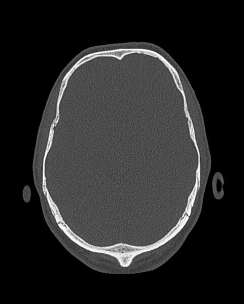File:Chronic maxillary sinusitis caused by a foreign body (Radiopaedia 58521-65676 Axial bone window 336).jpg