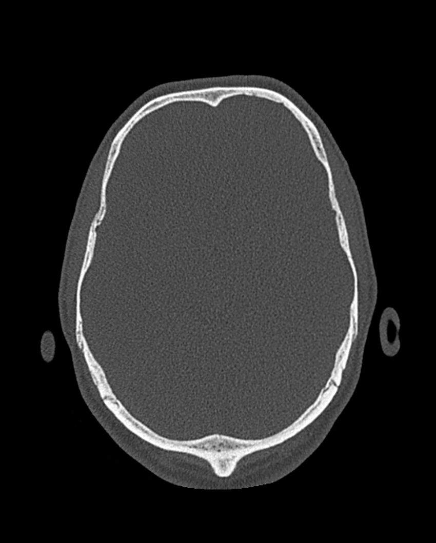 Chronic maxillary sinusitis caused by a foreign body (Radiopaedia 58521-65676 Axial bone window 336).jpg