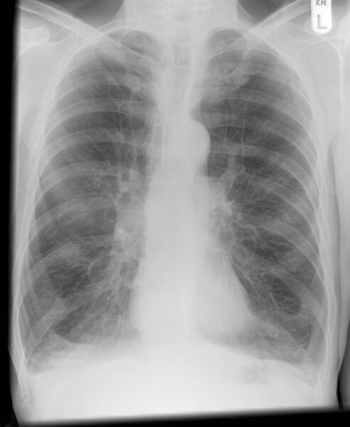 File:Chronic obstructive pulmonary disease (Radiopaedia 6410).jpg