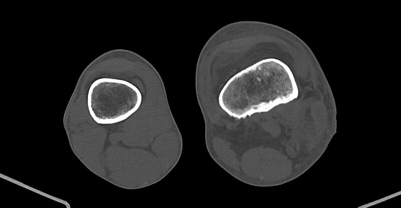 File:Chronic osteomyelitis (with sequestrum) (Radiopaedia 74813-85822 Axial 122).jpg