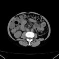 Chronic pancreatitis (Radiopaedia 23132-23172 Axial non-contrast 45).jpg