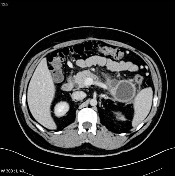 File:Chronic pancreatitis and pseudocysts (Radiopaedia 6724-7935 D 7).jpg