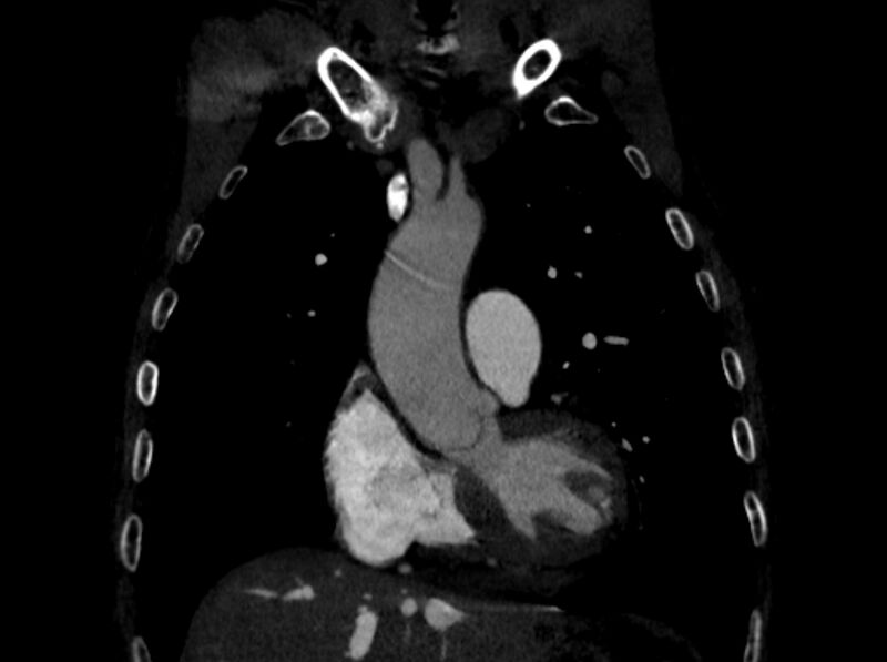 File:Chronic pulmonary embolism (Radiopaedia 91241-108843 A 31).jpg
