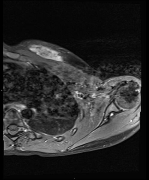 File:Chronic reactive multifocal osteomyelitis (CRMO) - clavicle (Radiopaedia 56406-63114 Axial T1 C+ fat sat 15).jpg