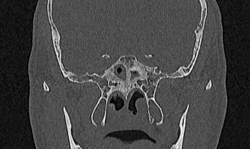 File:Chronic rhinosinusitis (Radiopaedia 65079-74075 Coronal bone window 69).jpg