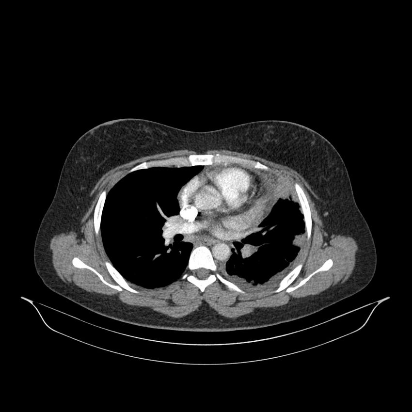 Chronic thromboembolic pulmonary hypertension (CTEPH) (Radiopaedia 74597-85532 Axial C+ CTPA 88).jpg