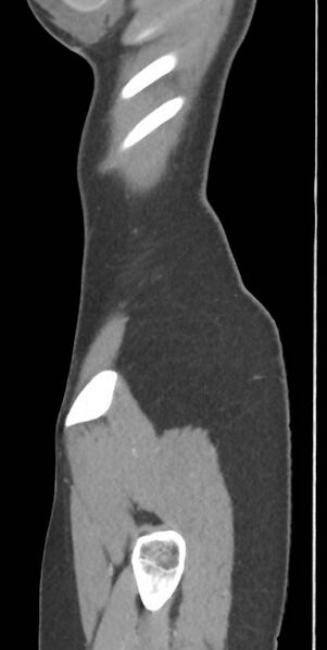 File:Circumaortic left renal vein with a duplicated retroaortic vein (Radiopaedia 91668-109398 C 1).jpg