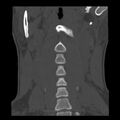Clay-shoveler fracture (Radiopaedia 22568-22590 Coronal bone window 3).jpg