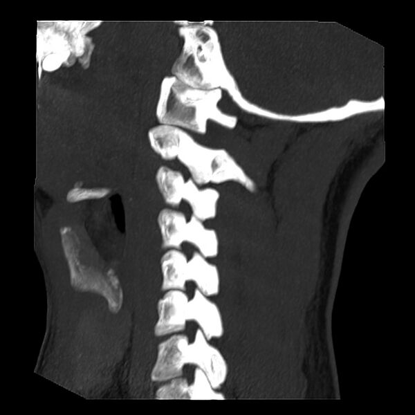 File:Clay-shoveler fracture (Radiopaedia 22568-22590 Sagittal MIP 5).jpg