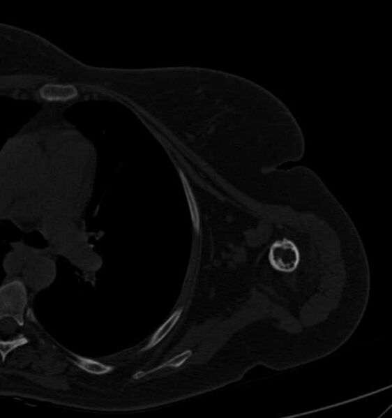 File:Clear cell chondrosarcoma - humerus (Radiopaedia 63104-71612 Axial bone window 73).jpg