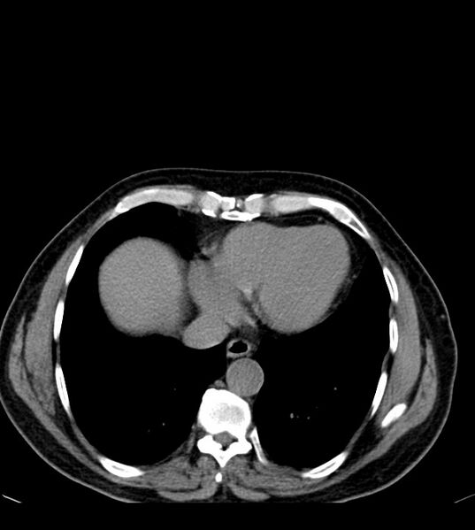 File:Clear cell renal cell carcinoma (Radiopaedia 85006-100539 Axial non-contrast 11).jpg
