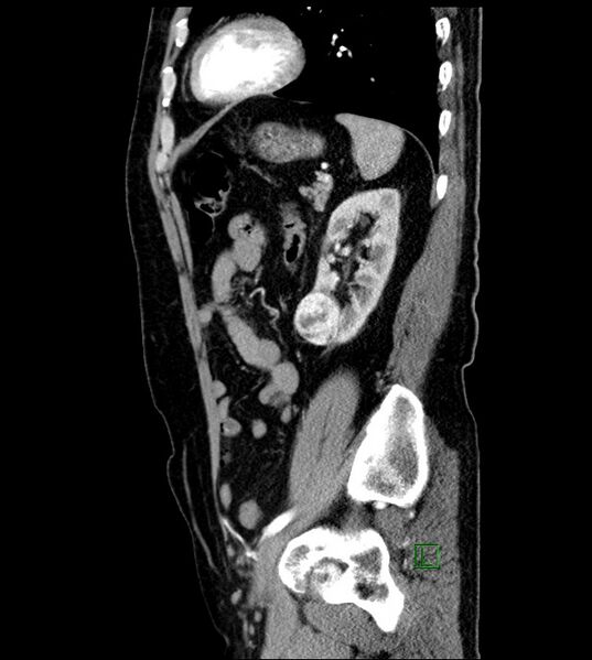 File:Clear cell renal cell carcinoma (Radiopaedia 85006-100539 E 17).jpg